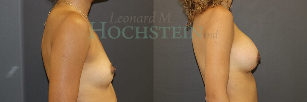 Breast Augmentation Patient