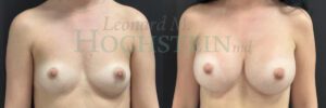 Breast Augmentation Patient 2504