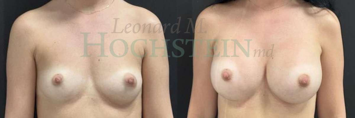 Breast Augmentation Patient