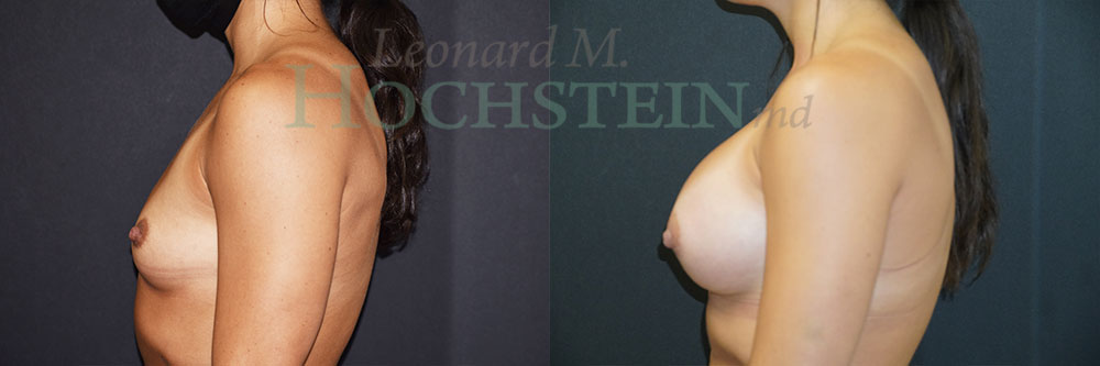 Breast Augmentation Patient