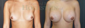 Breast Augmentation Patient