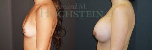 Breast Augmentation Patient