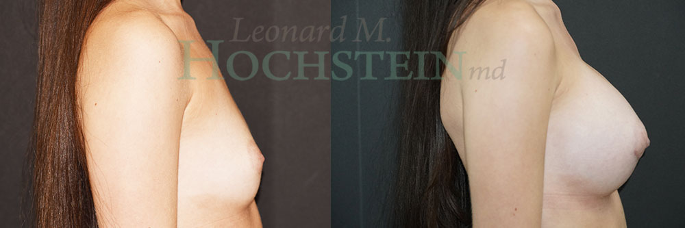 Breast Augmentation Patient