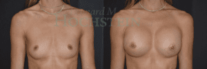 Breast Augmentation Patient 256