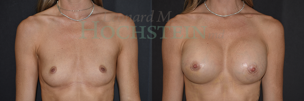 Breast Augmentation Patient