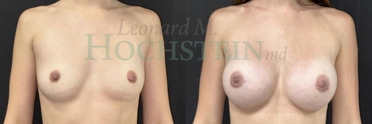 Breast Augmentation Patient