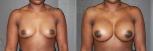 Breast Augmentation Patient
