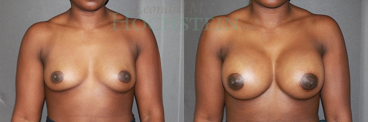 Breast Augmentation Patient