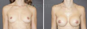 Breast Augmentation Patient