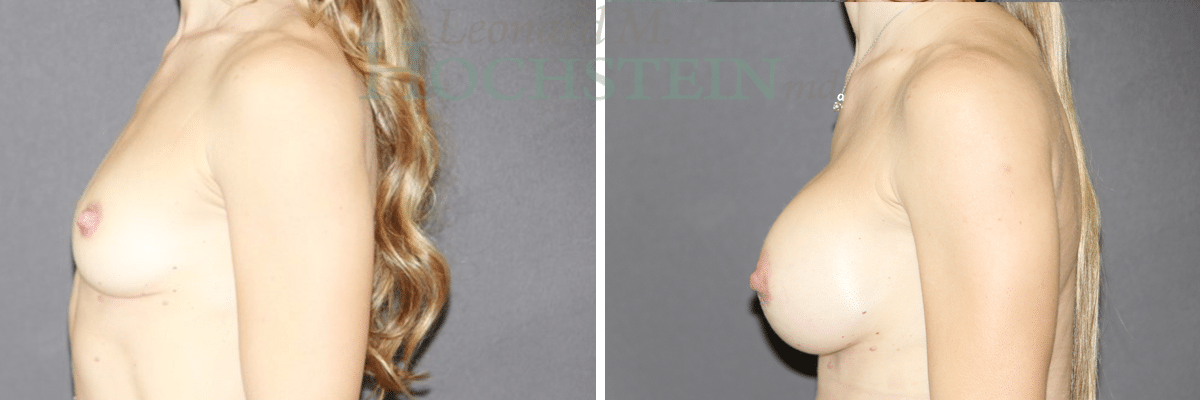 Breast Augmentation Patient