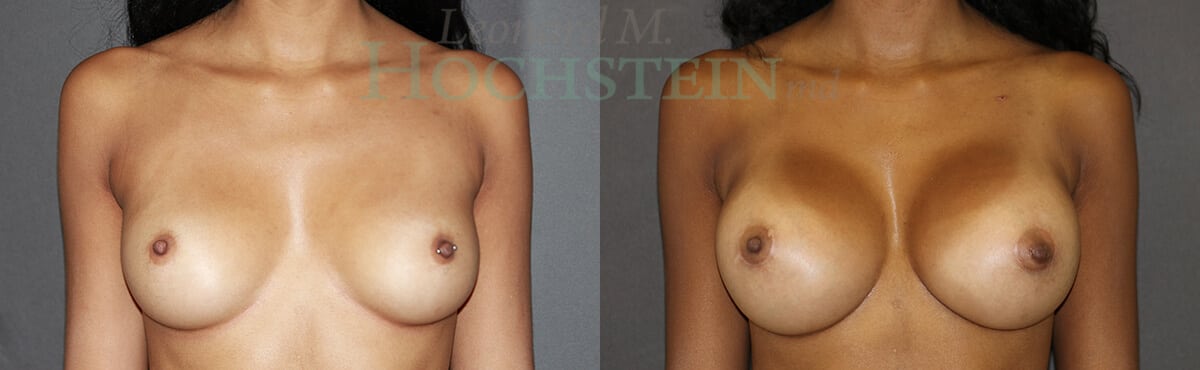 Breast Augmentation Patient