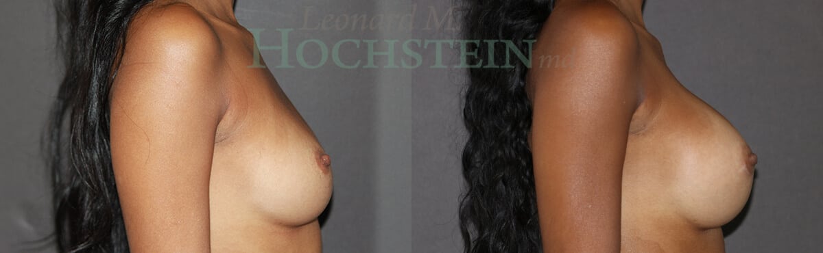 Breast Augmentation Patient