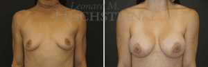 Breast Augmentation Patient