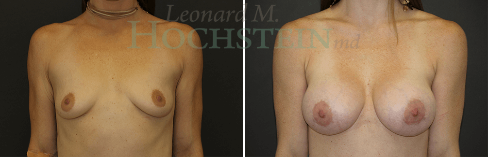 Breast Augmentation Patient