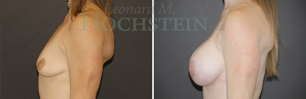 Breast Augmentation Patient