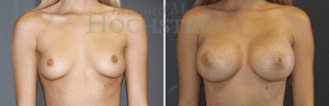 Breast Augmentation Patient