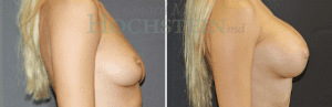 Breast Augmentation Patient