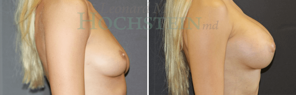 Breast Augmentation Patient
