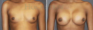 Breast Augmentation Patient