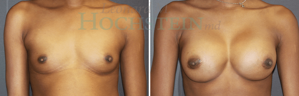 Breast Augmentation Patient