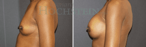 Breast Augmentation Patient