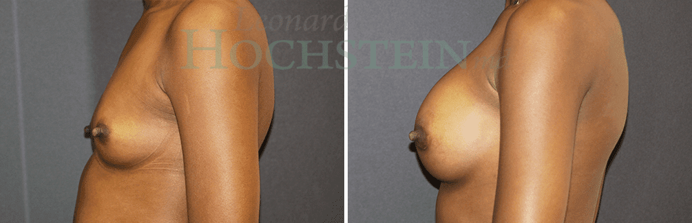 Breast Augmentation Patient