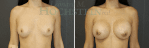 Breast Augmentation Patient