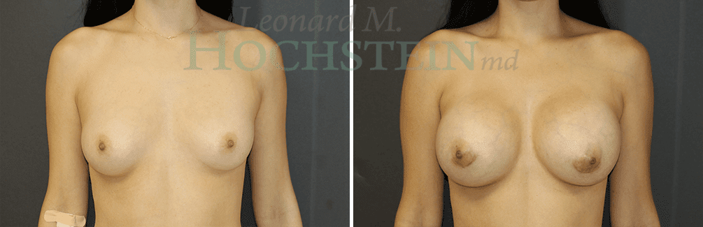 Breast Augmentation Patient