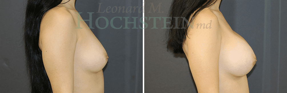 Breast Augmentation Patient