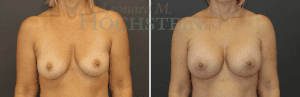 Breast Augmentation Patient