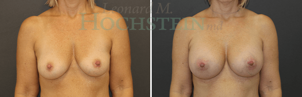 Breast Augmentation Patient