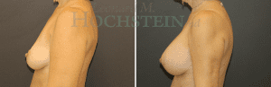 Breast Augmentation Patient