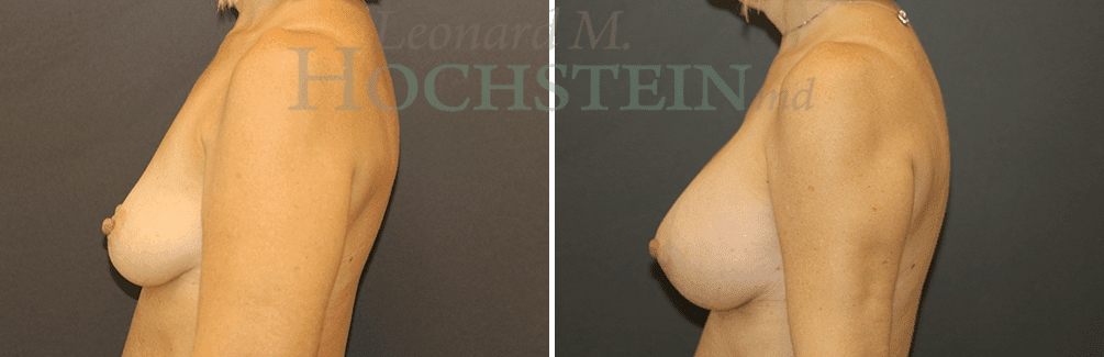 Breast Augmentation Patient