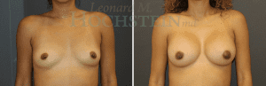 Breast Augmentation Patient 250