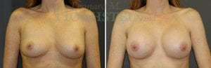 Breast Augmentation Patient 253