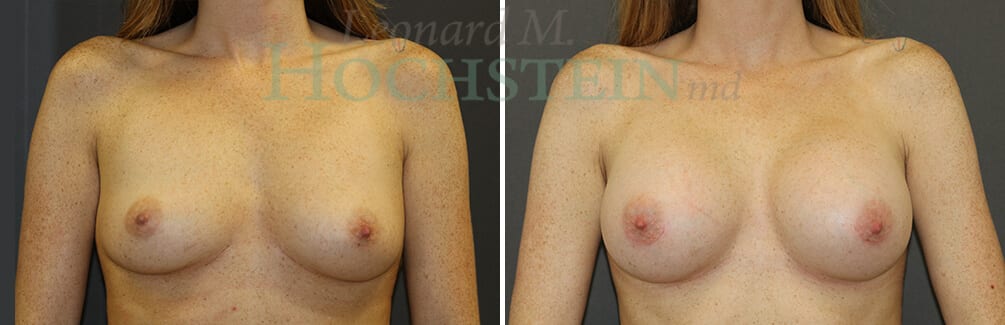 Breast Augmentation Patient
