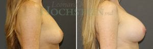 Breast Augmentation Patient