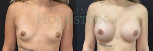 Breast Augmentation Patient 2207