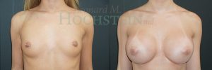 Breast Augmentation Patient