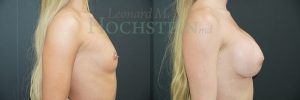 Breast Augmentation Patient