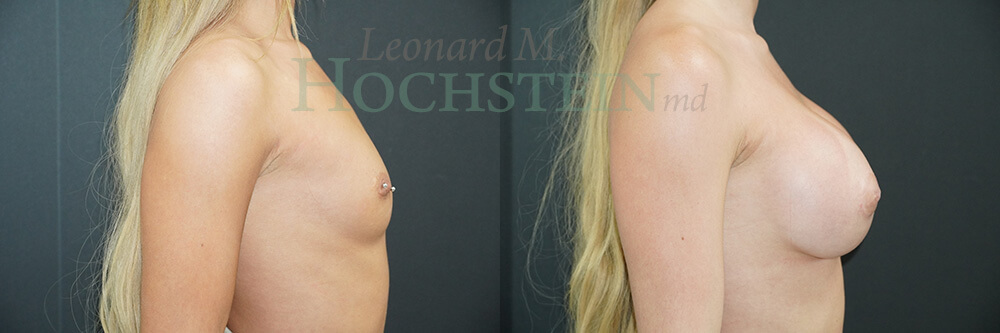 Breast Augmentation Patient