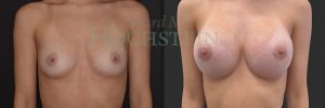 Breast Augmentation Patient 263