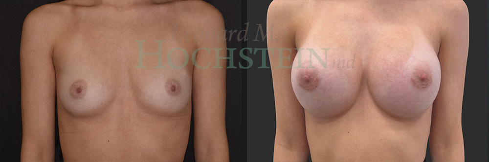 Breast Augmentation Patient
