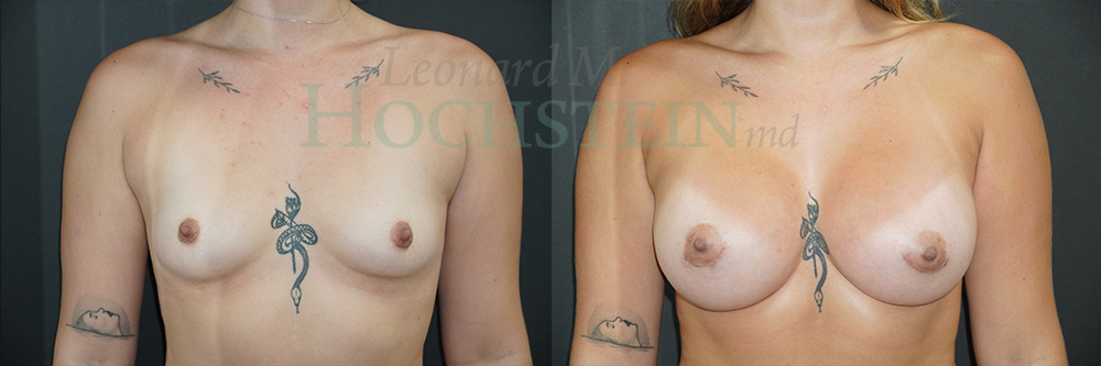 Breast Augmentation Patient