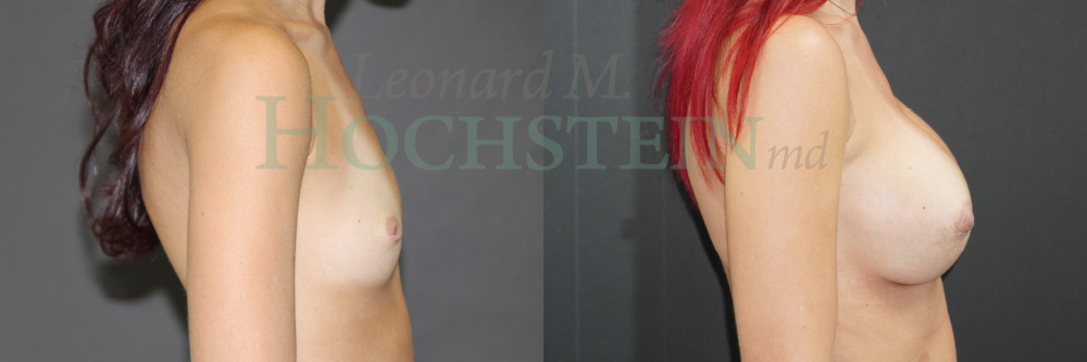 Breast Augmentation Patient