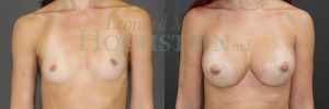 Breast Augmentation Patient