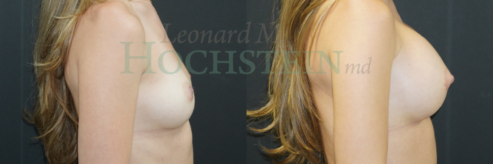 Breast Augmentation Patient