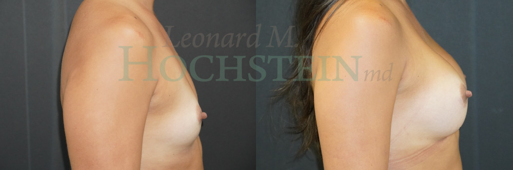 Breast Augmentation Patient