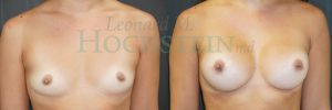 Breast Augmentation Patient