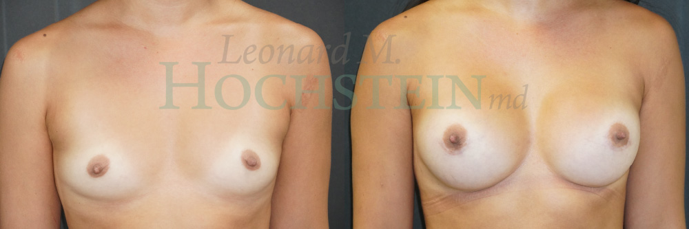 Breast Augmentation Patient